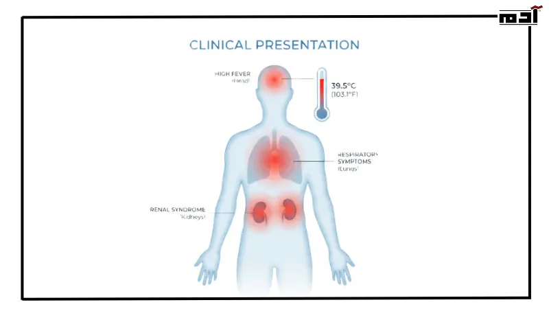 أعراض فيروس هانتا 