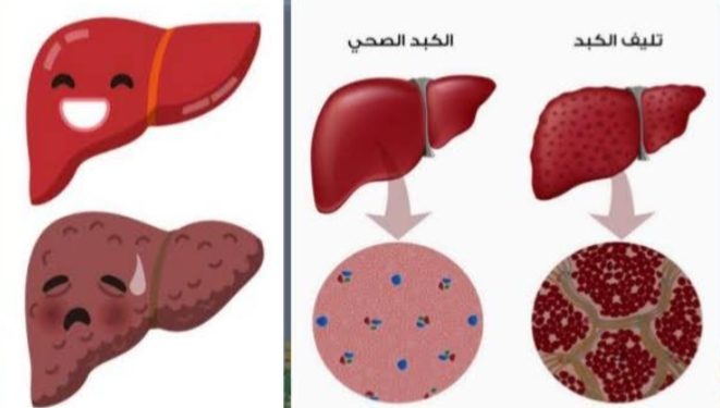 الالتهاب الكبدي الوبائي وأهم الفيروسات الكبدية وتأثيرها Adam Arts ادم ارتس 1043