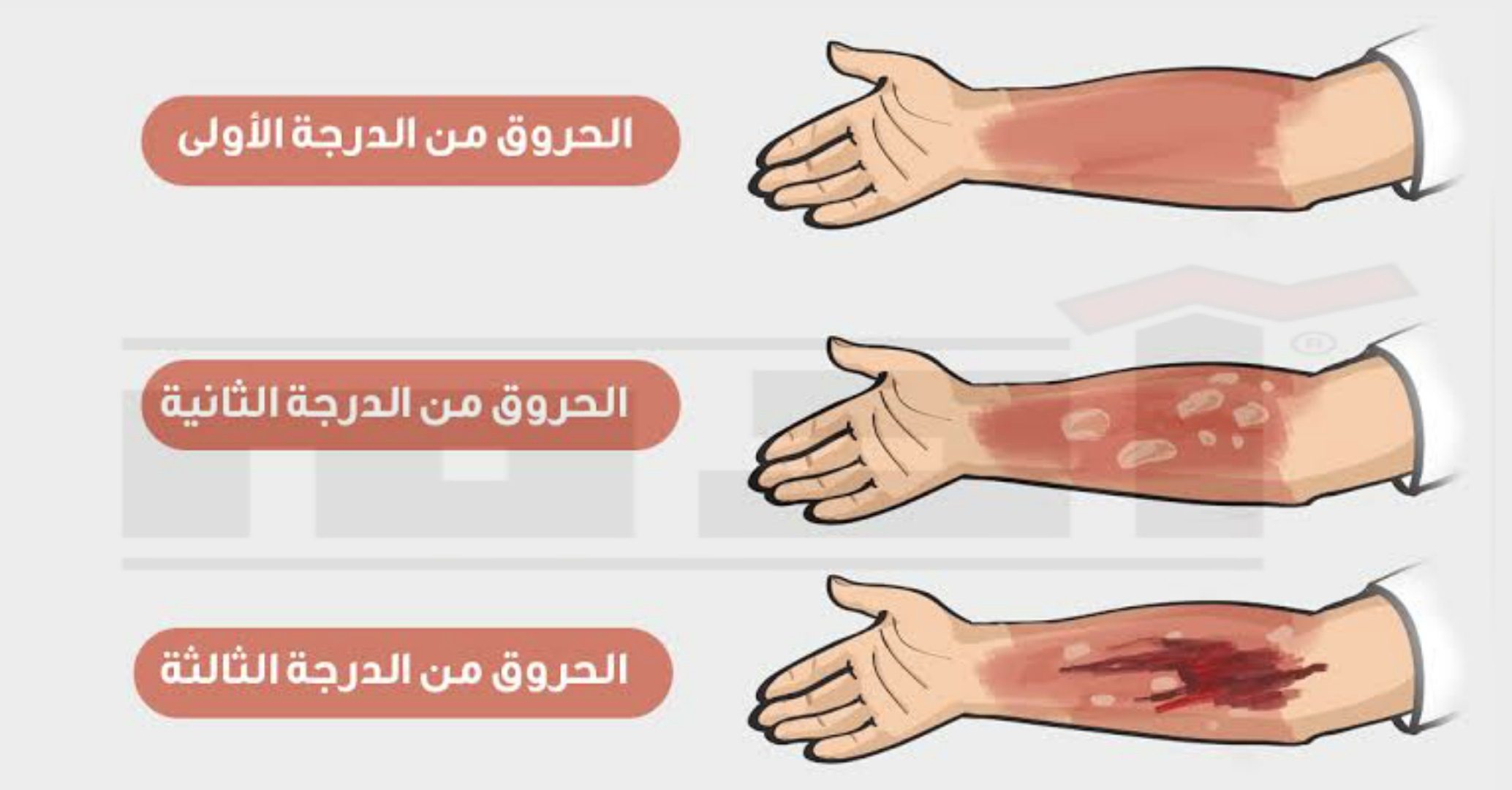 الحروق وطرق التعامل الصحيح كي لا تترك أثراً 2 درجات الحروق , الحروق من الدرجة الأولى , الحروق من الدرجة الثانية, الحروق من الدرجة الثالثة