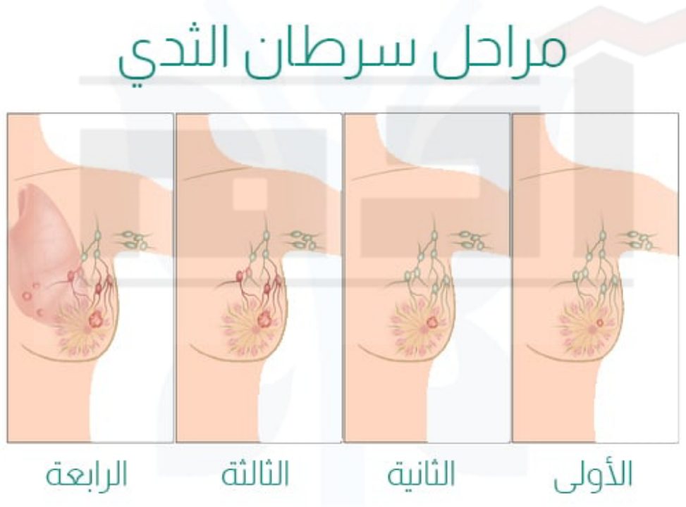 سرطان الثدي لا يرحم، تعرفي على طرق الوقاية والفحص الذاتي 2 كلما كان إكتشاف سرطان الثدي أبكر كلما ساهم ذلك في زيادة نسبة الشفاء