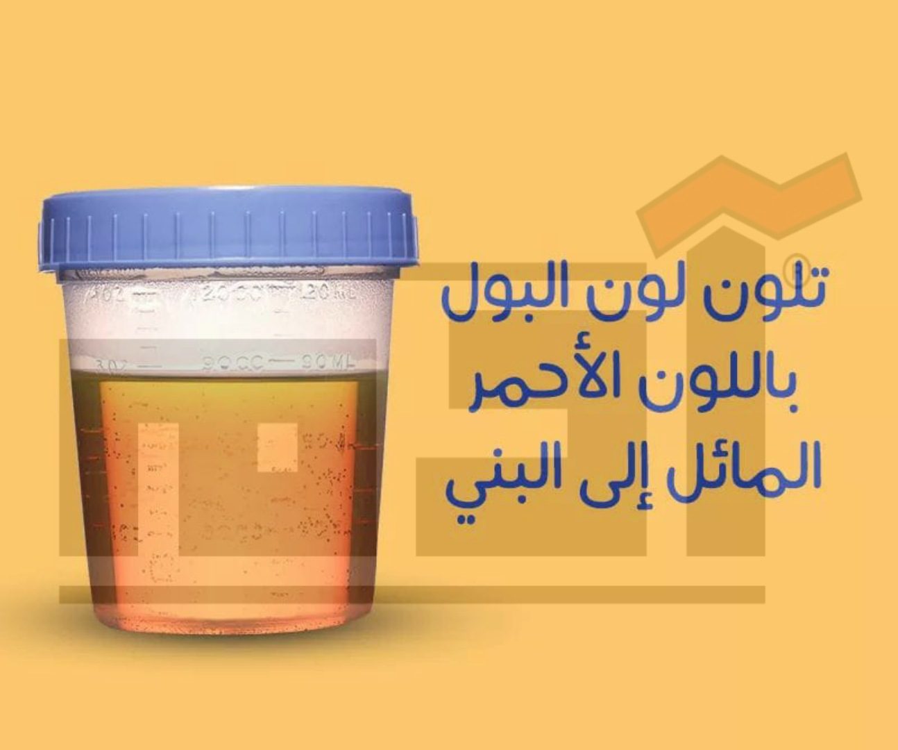 مرض أنيميا الفول عدد مصابيه أضعاف مصابي كورونا .. مدى خطورته على الأطفال 2 أعراض مرض أنيميا الفول , تلون البول باللون الأحمر