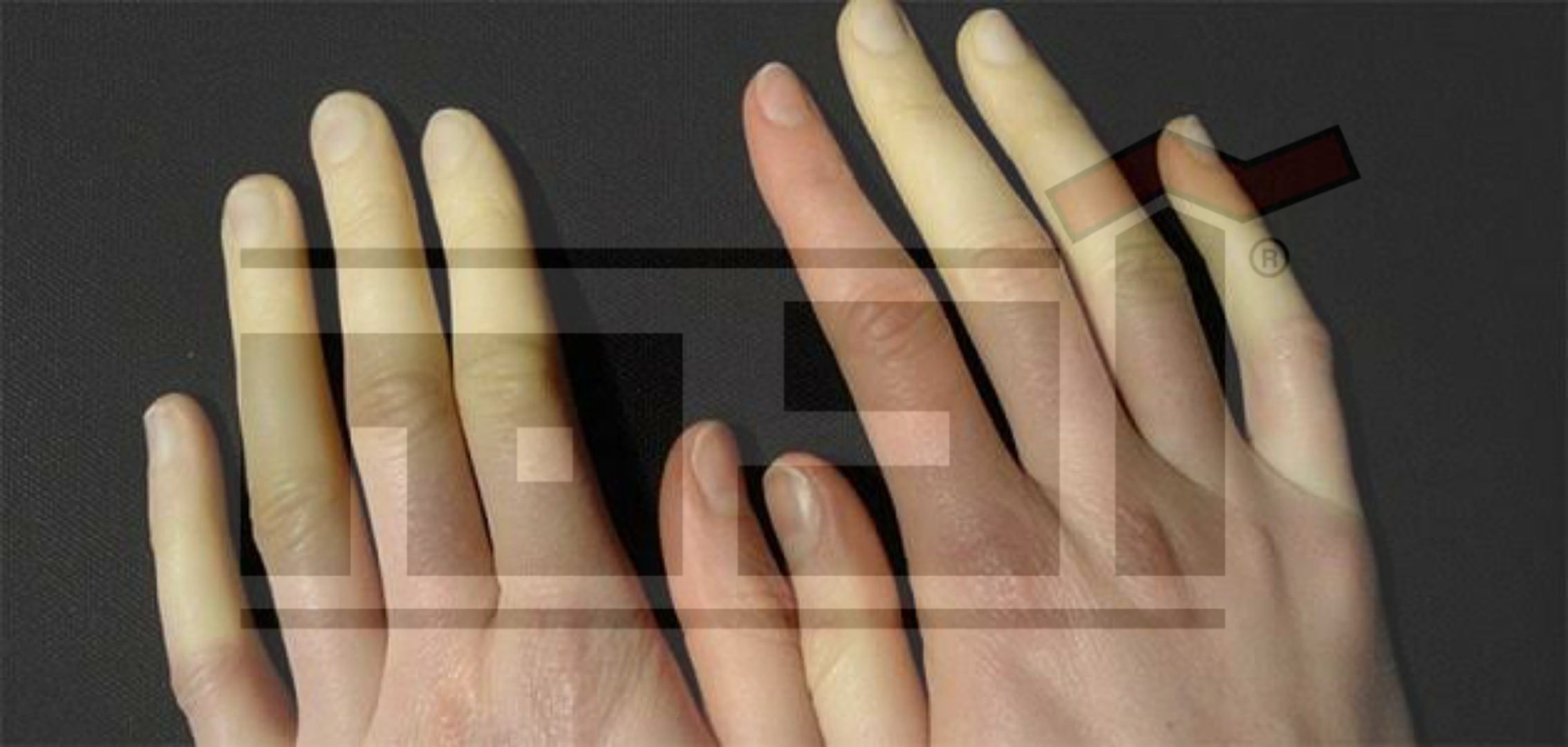 عضة البرد ... تعرف أعراض وعلاج تورم الأصابع خلال فصل الشتاء 1 تورم الأصابع , عضة البرد