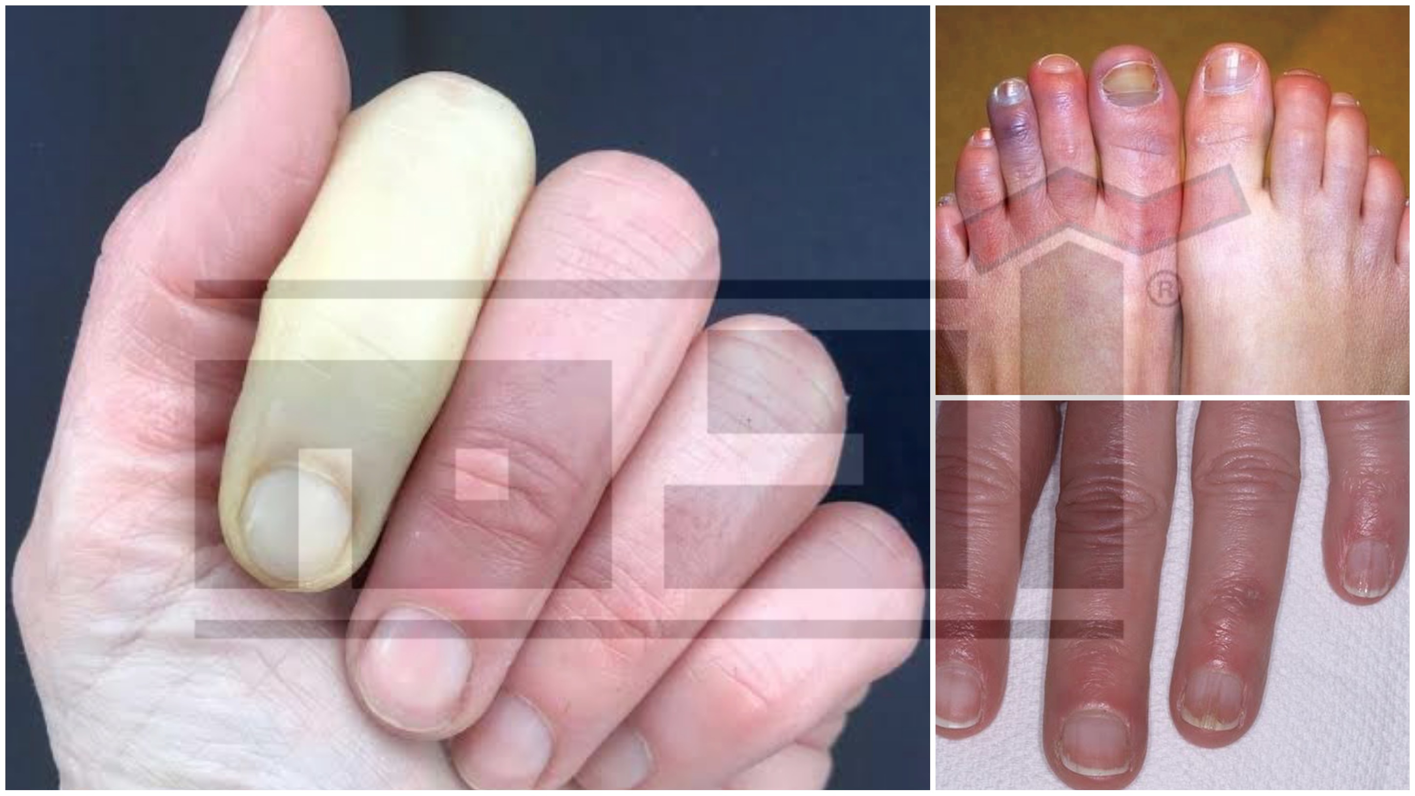 عضة البرد ... تعرف أعراض وعلاج تورم الأصابع خلال فصل الشتاء 2 تورم الأصابع , عضة البرد