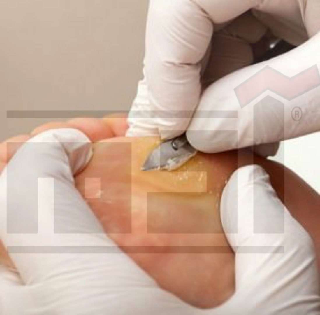 عين السمكة .. ثآليل القدم .. أعراضها وطرق علاجها والوقاية منها 2 عين السمكة , ثآليل القدم , wart