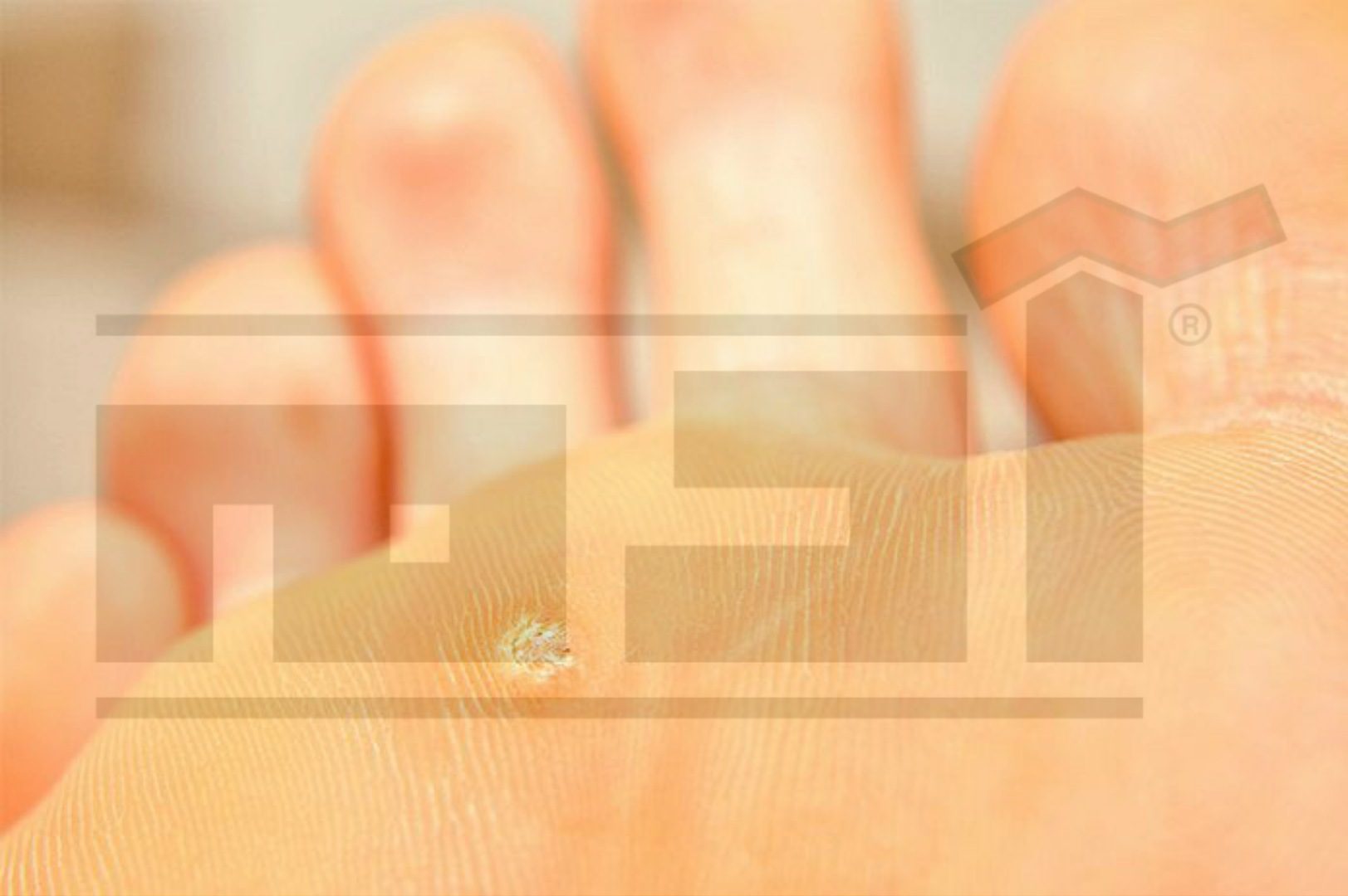 عين السمكة .. ثآليل القدم .. أعراضها وطرق علاجها والوقاية منها 1 عين السمكة , ثآليل القدم , wart