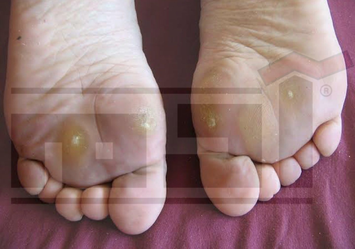 عين السمكة .. ثآليل القدم .. أعراضها وطرق علاجها والوقاية منها 3 عين السمكة , ثآليل القدم , wart