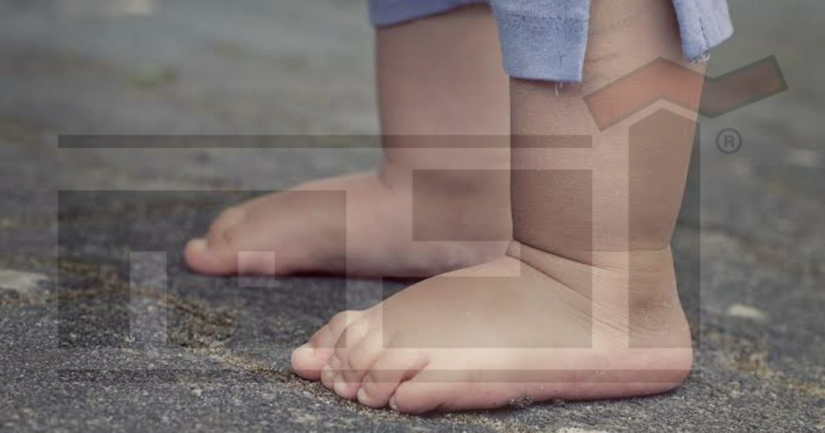 القدم المسطحة .. فلات فوت "flat foot" بين التشخيص والعلاج