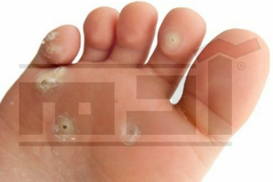 عين السمكة , ثآليل القدم , wart