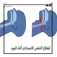 انقطاع النفس أثناء النوم.. ما هي أنواعه وأعراضه ومخاطره؟ 4 انقطاع النفس الانسدادي النومي (OSA)