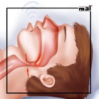 انقطاع النفس أثناء النوم.. ما هي أنواعه وأعراضه ومخاطره؟ 5 OSA المتوسط