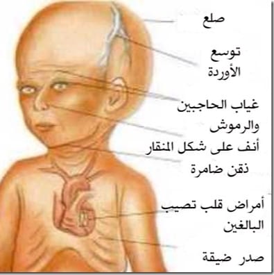 الشيخوخة المبكرة عند الأطفال "بروجيريا" 2 أعراض الشيخوخة المبكرة "البروجيريا"