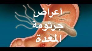 تعرف على علاج جرثومة المعدة 2022 2 علاج جرثومة المعدة