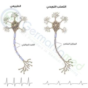 تعرف على مرض الـ MS أو التصلب اللويحي المتعدد وكيفية العلاج بـ3 طرق 5 التصلب اللويحي المتعدد