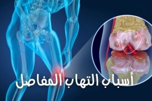 التهاب المفاصل.. وأبرز 10 أطعمة للتقليل منه 3 التهاب المفاصل