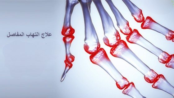 التهاب المفاصل.. وأبرز 10 أطعمة للتقليل منه 5 التهاب المفاصل