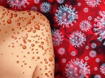 جدري القرود monkeypox أو جدري النسناس.. هل هو الوباء الجديد بعد كورونا؟