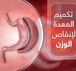 تكميم المعدة.. تعرف على أبرز 12 مخاطر لها 3 لماذا نلجأ إلى تكميم المعدة؟