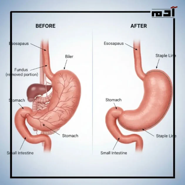 تكميم المعدة.. استئصال 80% من الحجم لوداع 7 أمراض خطيرة 2 لماذا نلجأ إلى تكميم المعدة