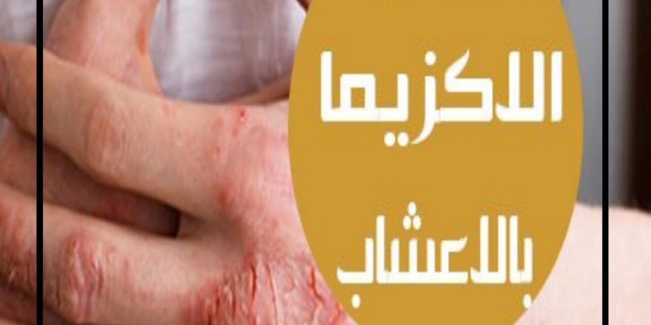 وداعًا للكريمات الكيميائية.. إليك علاج الإكزيما بالأعشاب