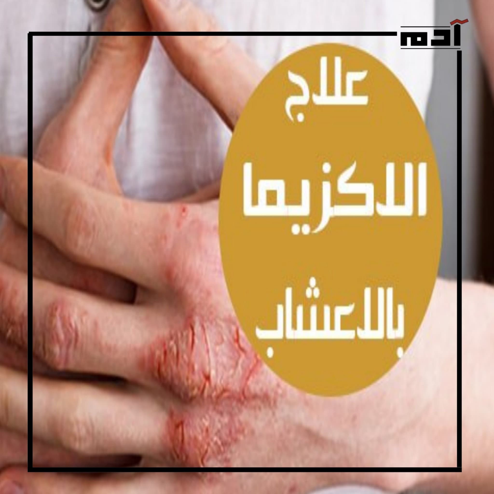وداعًا للكريمات الكيميائية.. إليك علاج الإكزيما بالأعشاب