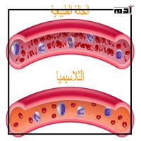 علاج كاسجفي.. أمل جديد لمرضى فقر الدم المنجلي والثلاسيميا 4 ما هو مرض الثلاسيميا؟