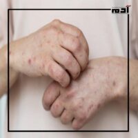 ماذا تعرف عن جدري ألاسكا؟