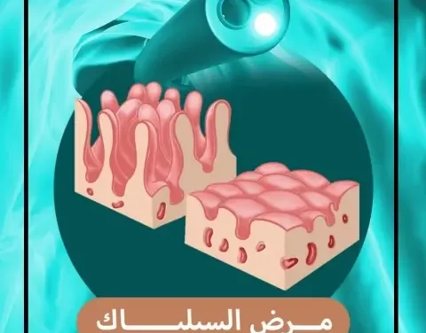 هل تعاني بصمت؟.. تعرف على مرض السيلياك وأسبابه الخفية