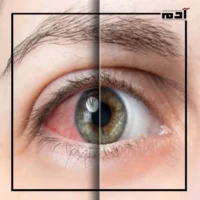 صحتك في خطر.. أبرز أضرار تكييف الهواء على الصحة 2 جفاف العيون