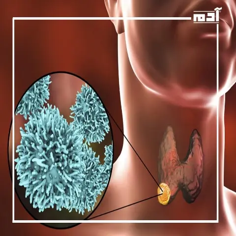 أورام الغدة الدرقية والعقيدات