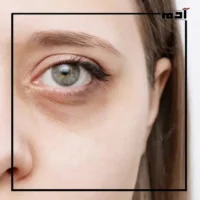 كيف تجعل عينيك تشرق؟.. سر التخلص من الهالات السوداء 2 أسباب ظهور الهالات السوداء