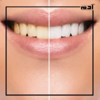 اصفرار الأسنان بعد التقويم.. الأسباب الخفية وكيفية معالجتها 1 ما أعراض اصفرار الأسنان بعد التقويم؟