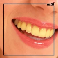 اصفرار الأسنان بعد التقويم.. الأسباب الخفية وكيفية معالجتها 2 كيفية القضاء على اصفرار الأسنان بعد التقويم؟