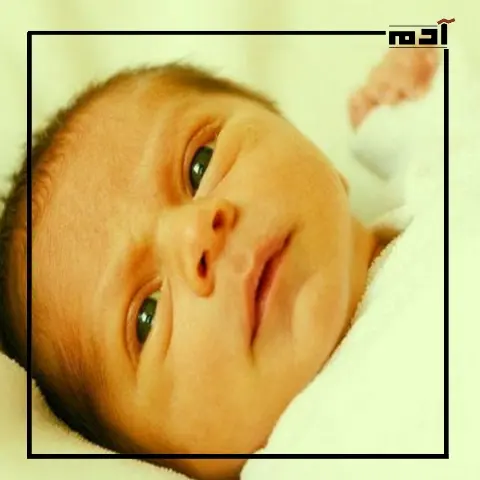الصفراء عند حديثي الولادة.. الأسباب، والأعراض، والعلاج
