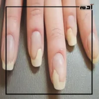 اكتشف أسباب فطريات الأظافر وكيف تتخلص منها 2 أعراض فطريات الأظافر