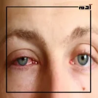 أمراض تصيب عينك في الصيف.. دليلك للوقاية الفورية 1 التهاب الملتحمة