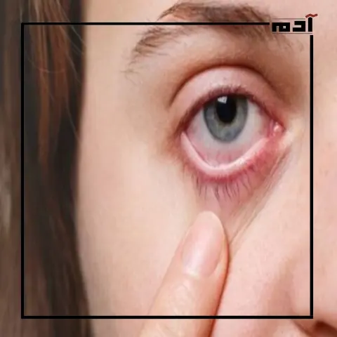أمراض تصيب عينك في الصيف.. دليلك للوقاية الفورية
