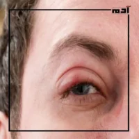 أمراض تصيب عينك في الصيف.. دليلك للوقاية الفورية 2 التراخوما