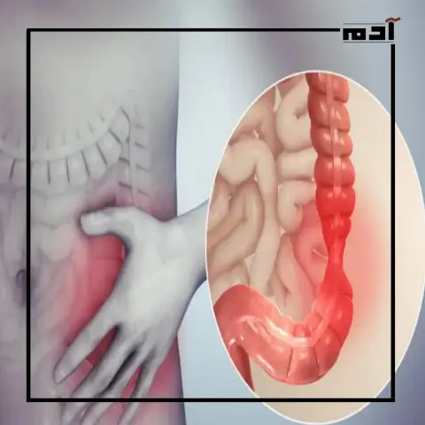 علاج القولون العصبي نهائيًا