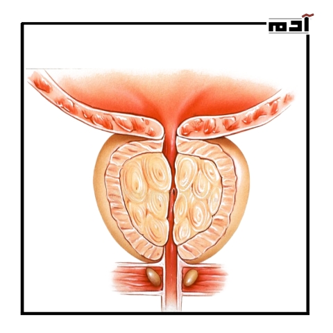 علاج البروستاتا