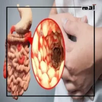مرض كرون