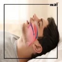 Sleep apnea.. Discover modern scientific treatments 1 Sleep apnea syndrome