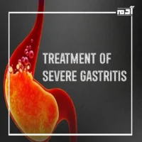 Treatment of gastritis.. How to overcome pain and avoid serious complications 1 Treatment of severe gastritis