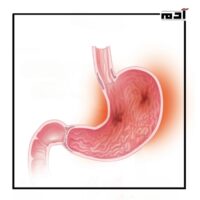 Treatment of gastritis.. How to overcome pain and avoid serious complications 3 Symptoms of severe gastritis