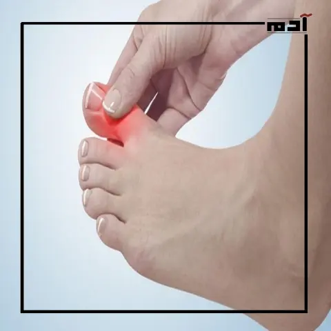 هل تنميل أصابع القدم ينذر بخطر صحي؟.. اكتشف الحقيقة