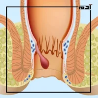 علاج البواسير المثالي.. خطوات عملية نحو الشفاء 3 أعراض البواسير