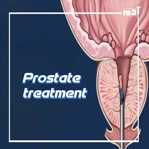 Prostate treatment.. Simple steps to reduce pain and complications
