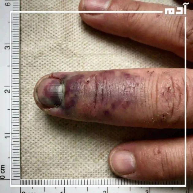 أسباب الإصبع المدوحس