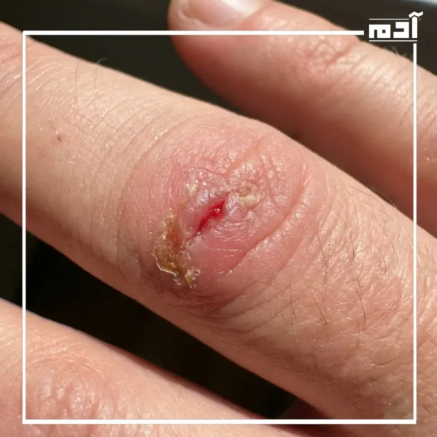 أسباب القيح تحت الجلد