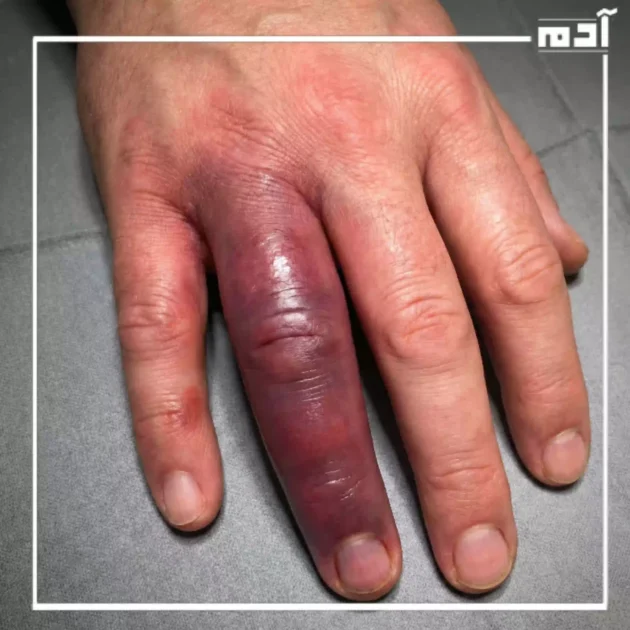 أعراض الإصبع المدوحس وتورم الأنسجة