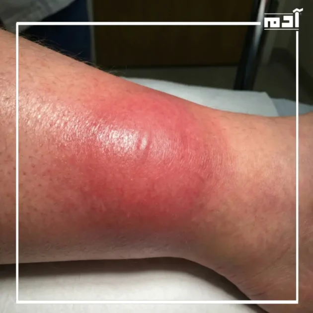 أعراض القيح والتهاب الجلد البكتيري